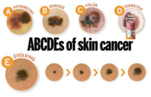 Skin Cancer Surgery/Treatment in Denver, CO